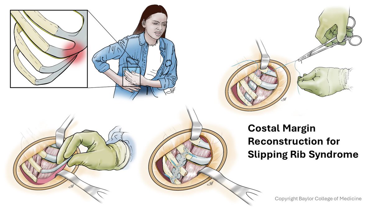 R. Taylor Ripley, M.D. Thoracic Surgeon (@rtaylorripley) on Twitter photo Excited to start our Slipping Rib Syndrome program <a href="/BCM_Surgery/">BCM_Surgery</a> <a href="/BCM_Thoracic/">David J. Sugarbaker Division of Thoracic Surgery</a> <a href="/bcmhouston/">BCMHouston</a>. Great artwork of 'Costal Margin Reconstruction' by <a href="/ScottHolmesCMI/">Scott Holmes, CMI</a> Excited to start our Slipping Rib Syndrome program <a href="/BCM_Surgery/">BCM_Surgery</a> <a href="/BCM_Thoracic/">David J. Sugarbaker Division of Thoracic Surgery</a> <a href="/bcmhouston/">BCMHouston</a>. Great artwork of 'Costal Margin Reconstruction' by <a href="/ScottHolmesCMI/">Scott Holmes, CMI</a>