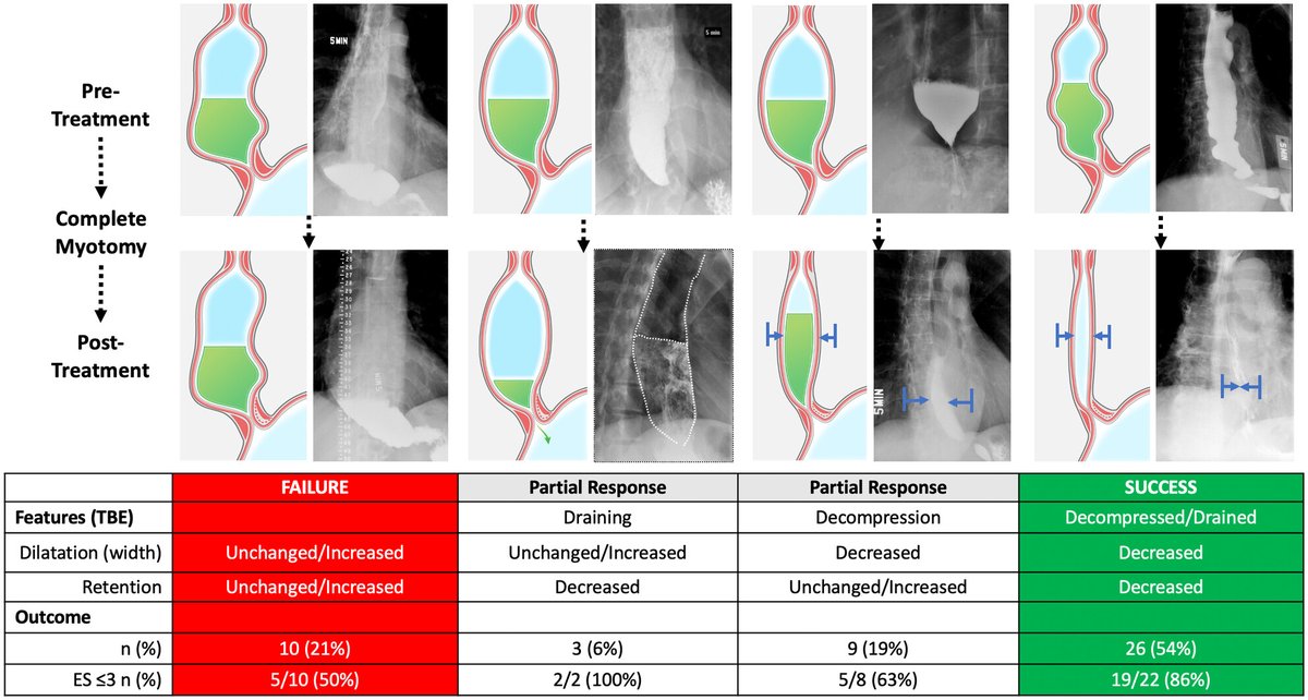 NGMJournal's tweet photo. @maura_corsetti @IBS_Maastricht @DrCJBlack @AndreaShin_GI @mpj61 @VorkLisa @ThisIsButt @Pierfra_Visaggi @Rajan___Singh @ANMSociety @esnm_eu @BMoshiree @DrvanTilburg @karagm2009 @LindaNguyenMD @SSrinivasanMD @KashyapPurna @BeyderLab @mgrover_gi @PaulMoayyedi @eamonnquigleymd @MagnusSimren @VannerStephen @emadelomar @NehaSantucciMD @ShimaghavimiMD @LumirKunovsky @DharJahnvi @WalterChanMD @MelchiorChloe @stevenbollipo @doc_zubin @FcoLajudBarquin ๐ฅ#EsophagealRecoil (greater #EsophagealBody width โฌ๏ธ) is associated with good #ClinicalOutcome (#BariumRetention on #TBE & symptomatic outcome) in patients without post-treatment #EGJ obstruction #NonSpastic #Achalasia
๐https://t.co/0eXDBU37dP๐
@ANMSociety @esnm_eu #GITwitter https://t.co/QZQ753PKVn