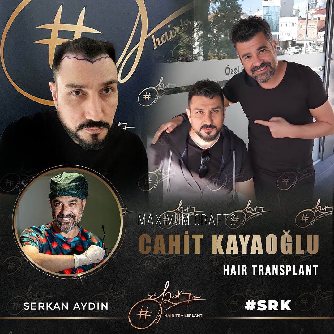 Arenamedd's tweet photo. Natural Hairline Restoration with DHI Method 🎨🧑‍🎨
#cahitkayaoglu
Contact us now for a Free Hair Analysis!

#serkanaydin #maximumgrafts #hairtransplant #beardtransplant #stemcell #haartransplant #Stammzellen #maximalgraft #maximaktransplantation #barttransplant https://t.co/yj1f51h69e