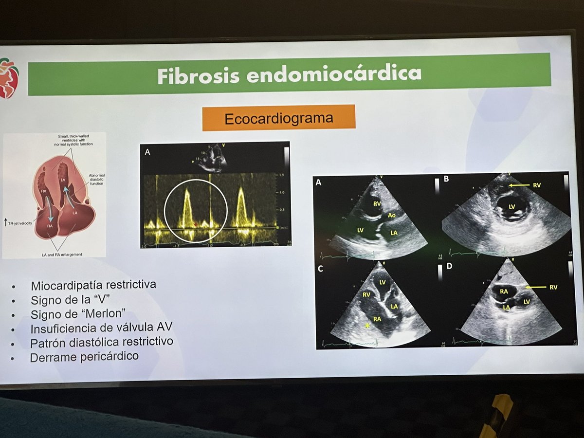 EugenioCingolan's tweet photo. Ahora en @CongresoSIAC @SIAC_MCP @SIAC_cardio ➡️ Dra. Lili Posada @LiliPosadaM 🇲🇽 ➡️ #Enfermedadestropicales #Fibrosis #ConductionSystem #CCS ➡️➡️ I see fibrosis I think #VT ! https://t.co/beN48iLR3S