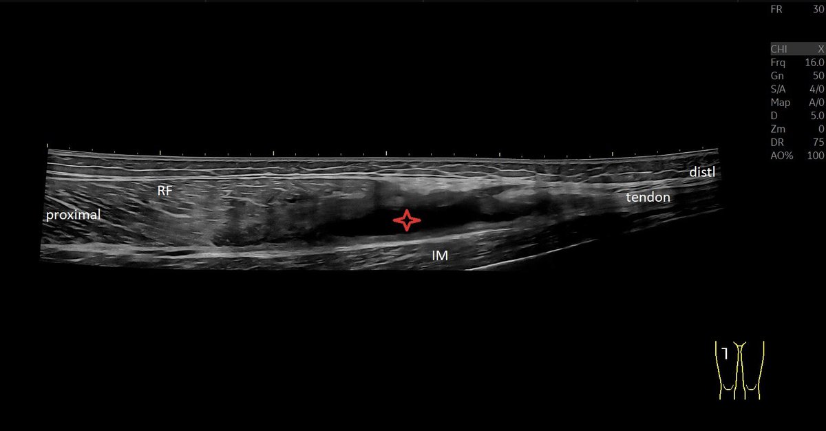 SportklinikBern's tweet photo. Large #muscleinjury of the #rectusfemoris with large hematoma—> #ultrasoundguidedpuncture - #mskus #pocus #pocushub #GElogiqE10r3 https://t.co/OxhaSK3nbv