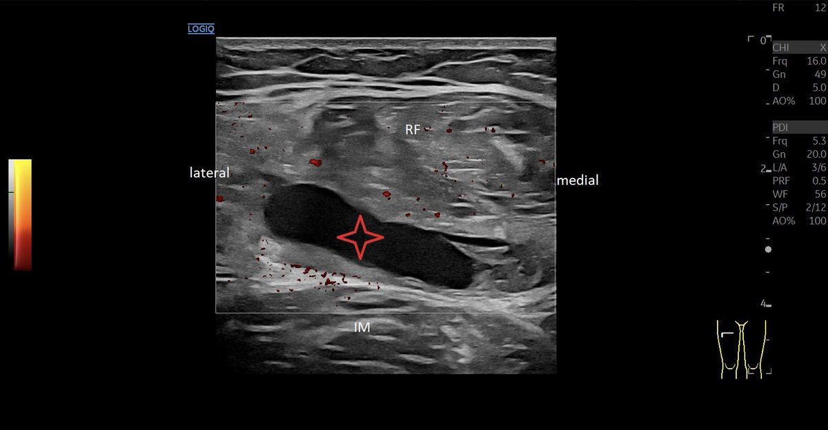SportklinikBern's tweet photo. Large #muscleinjury of the #rectusfemoris with large hematoma—> #ultrasoundguidedpuncture - #mskus #pocus #pocushub #GElogiqE10r3 https://t.co/OxhaSK3nbv