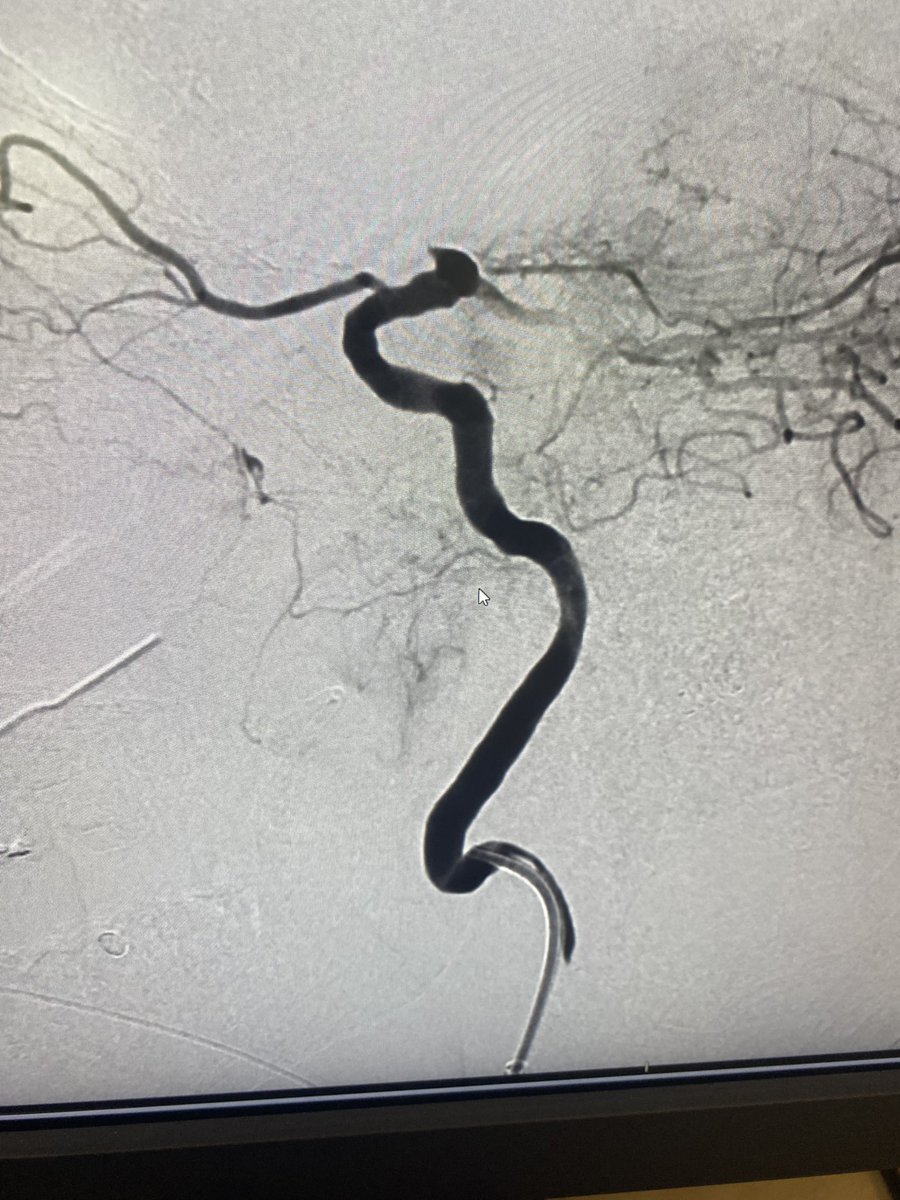 Beautiful mandibulovidian artery <a href="/EricRSmithMD/">Eric R Smith</a> #neurointervention <a href="/SNISinfo/">SNIS Info</a>