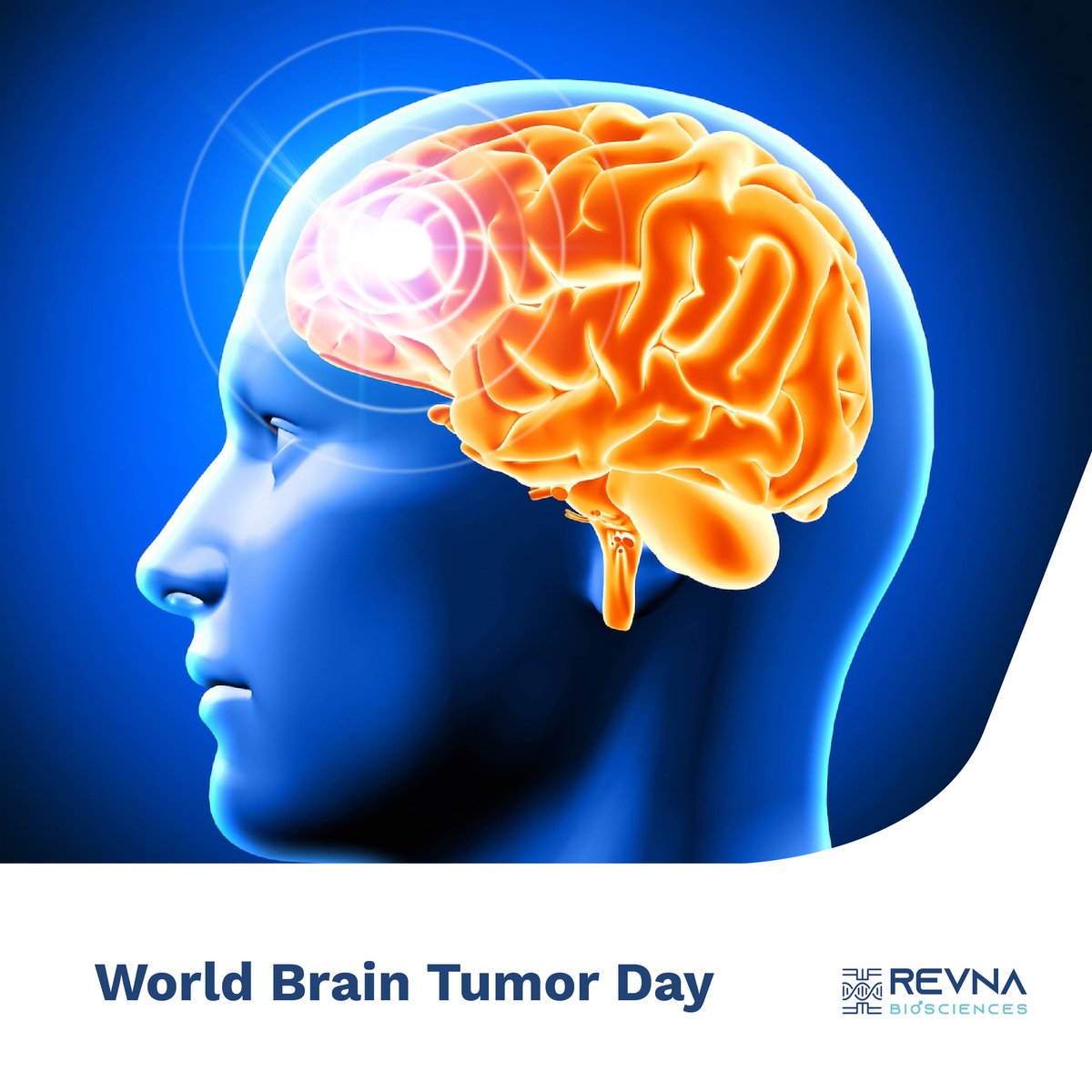 RevnaBio's tweet photo. This international day (June 8th) serves as a powerful platform to raise awareness about brain tumors.
Join Revna Biosciences as we raise awareness this World Brain Tumor Day. #TumorDay2024 #WorldBrainTumorDay #BrainHealthMatters #ProtectYourBrain #ShineALightOnBrainTumor #Revna https://t.co/JjnX7JS6yE