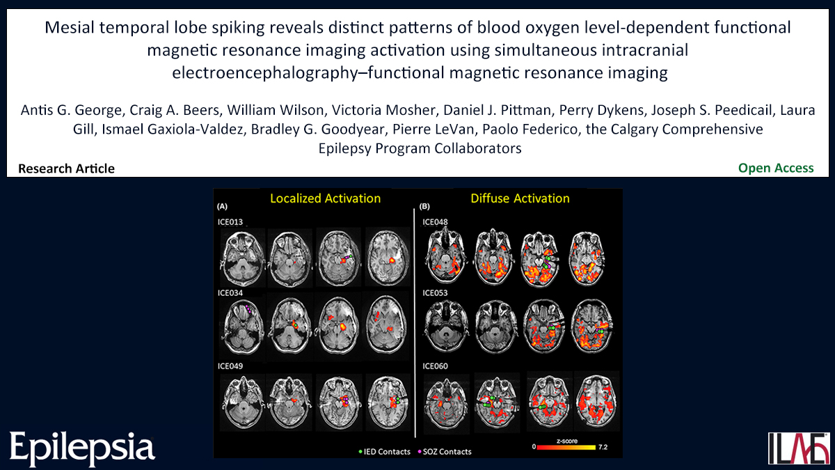 EpilepsiaJourn's tweet photo. Key point: In patients with widespread fMRI activation, 73% reported <1 focal to bilateral tonic–clonic seizure per month.
https://t.co/7Sd4Hs2h84

#epilepsy #ilae #EEGfMRI #intracranialEEG  #epileptiformdischarge  #BOLDresponse #temporallobe @IlaeWeb @epilepsiajourn @WileyNeuro https://t.co/ztTBMUb95R