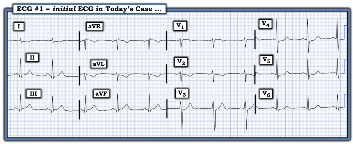 ekgpress's tweet photo. This ECG is from an older man with new but atypical CP (Chest Pain). Given this history — How would YOU interpret this ECG? — Which lead convinced me? — GO TO — https://t.co/MwPIZsKMvw —#ECG - #ECG_Ken_Grauer - #EKG — :) https://t.co/b5CSGK5NJB