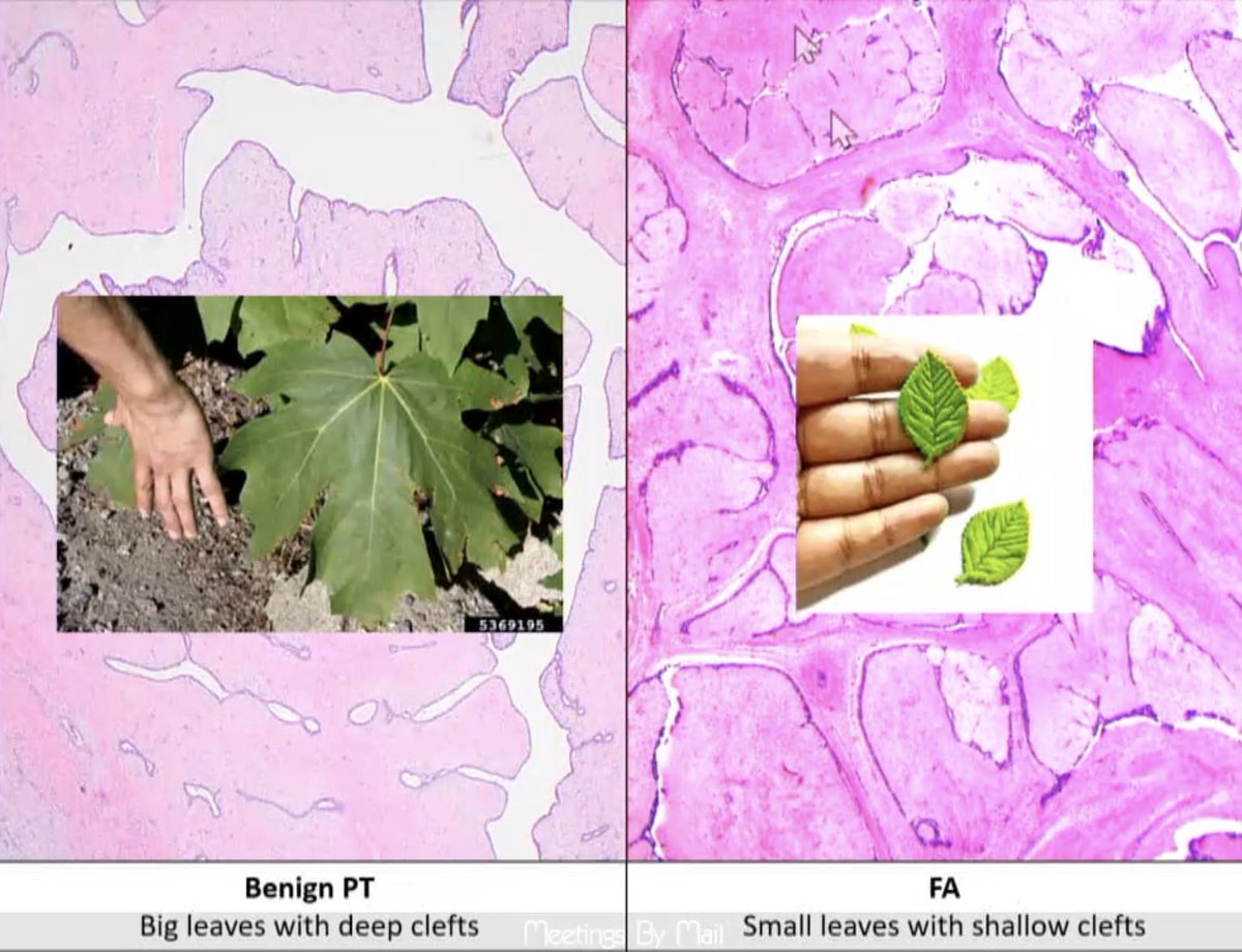 Phylloid Pattern #EverydayBreast Fibroadenoma vs Phyllodes Expanded stroma/ leaf like ...
