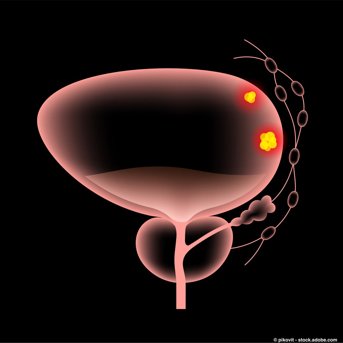OncLive.com (@onclive) on Twitter photo The European Commission has approved nivolumab paired with cisplatin and gemcitabine for the first-line treatment of adult patients with unresectable or metastatic urothelial carcinoma. <a href="/MichvdHeijden/">Michiel van der Heijden</a> <a href="/NKI_nl/">The Netherlands Cancer Institute</a> #oncology #blcsm onclive.com/view/frontline… The European Commission has approved nivolumab paired with cisplatin and gemcitabine for the first-line treatment of adult patients with unresectable or metastatic urothelial carcinoma. <a href="/MichvdHeijden/">Michiel van der Heijden</a> <a href="/NKI_nl/">The Netherlands Cancer Institute</a> #oncology #blcsm onclive.com/view/frontline…