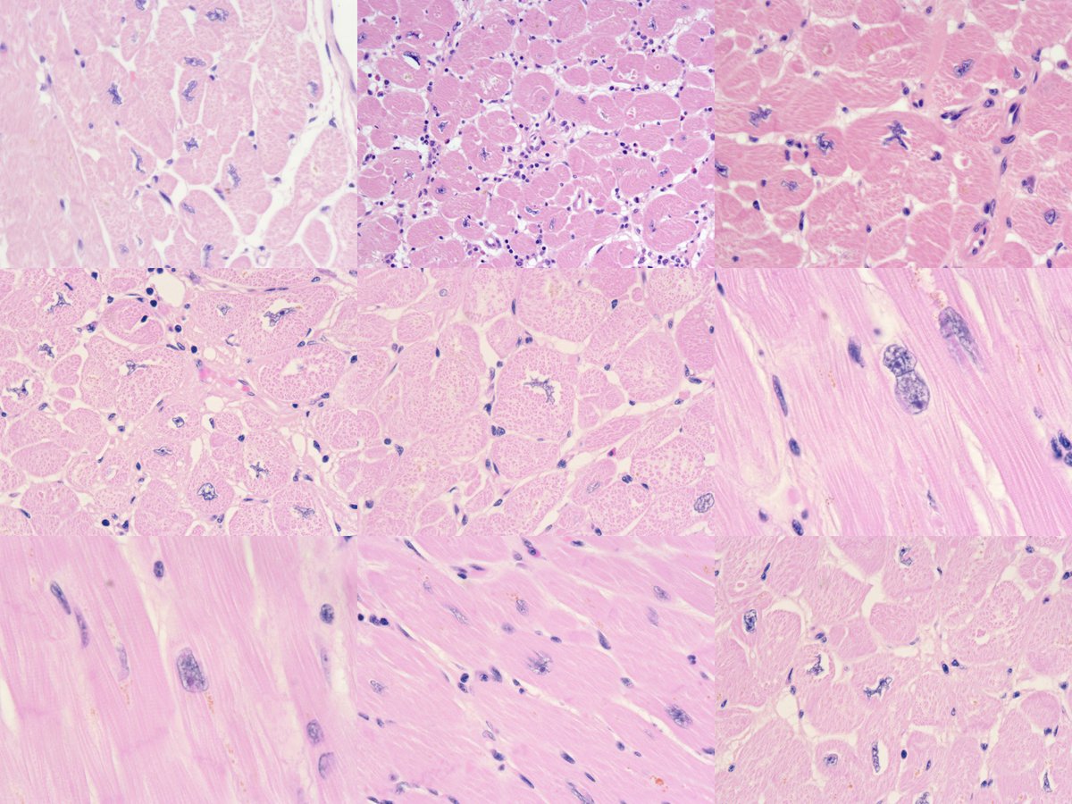 Michael Seidman (@mseidmanmd) on Twitter photo #Cardiomyocyte nuclear #pleomorphism and irregular nuclear contours - it's pathology Rorschach! <a href="/scvp1/">SCVP</a> <a href="/CVpathol/">Cardiovascular Pathology</a> <a href="/MelanieBoisMD/">Melanie Bois</a> <a href="/joemaleszewski/">Joe Maleszewski, MD</a> <a href="/Marc_Halushka/">Marc Halushka MD PhD</a> <a href="/IHC_guy/">Andrew Bellizzi 🇺🇦</a> <a href="/KMirza/">Kamran Mirza MD PhD - کامران مرزا</a> #Cardiomyocyte nuclear #pleomorphism and irregular nuclear contours - it's pathology Rorschach! <a href="/scvp1/">SCVP</a> <a href="/CVpathol/">Cardiovascular Pathology</a> <a href="/MelanieBoisMD/">Melanie Bois</a> <a href="/joemaleszewski/">Joe Maleszewski, MD</a> <a href="/Marc_Halushka/">Marc Halushka MD PhD</a> <a href="/IHC_guy/">Andrew Bellizzi 🇺🇦</a> <a href="/KMirza/">Kamran Mirza MD PhD - کامران مرزا</a>