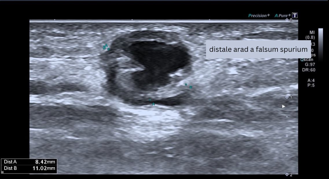 AngioUpdates's tweet photo. 3h follow-up post-thrombin injection of postinterventional aneurysma spurium => distal right radial artery following localized puncture during coronary angiography https://t.co/0FqgFjWYn3