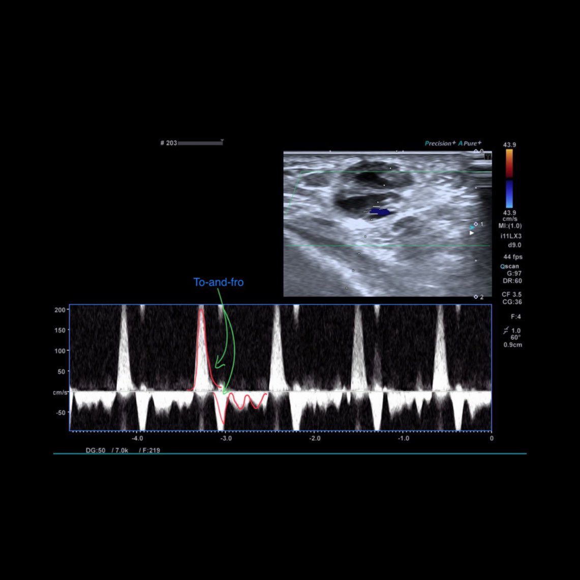 AngioUpdates's tweet photo. 3h follow-up post-thrombin injection of postinterventional aneurysma spurium => distal right radial artery following localized puncture during coronary angiography https://t.co/0FqgFjWYn3