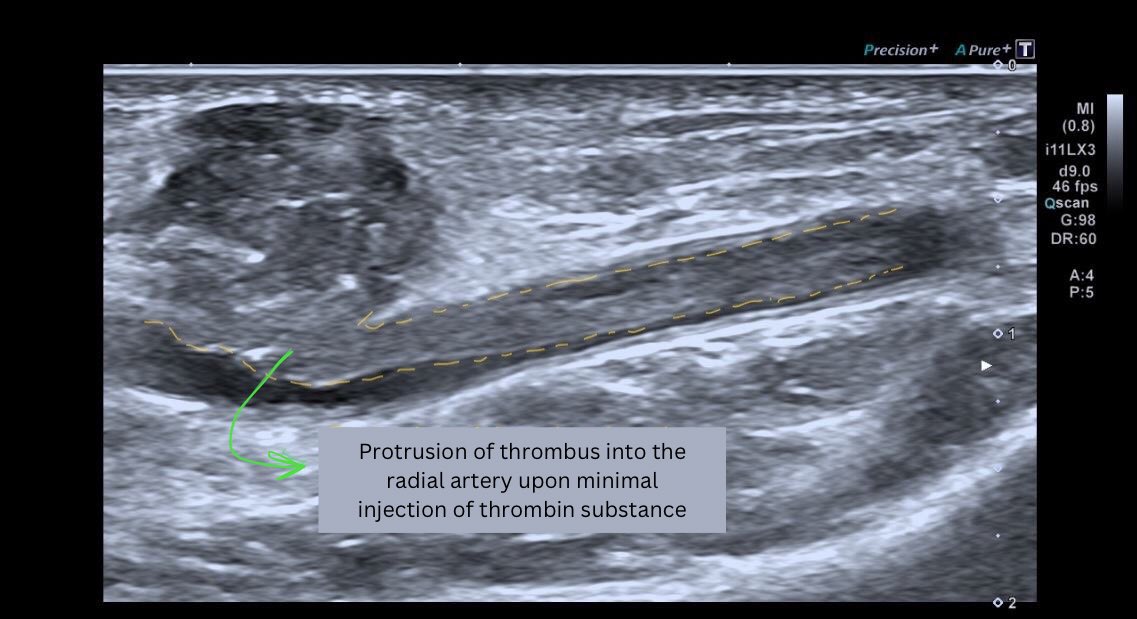 AngioUpdates's tweet photo. 3h follow-up post-thrombin injection of postinterventional aneurysma spurium => distal right radial artery following localized puncture during coronary angiography https://t.co/0FqgFjWYn3