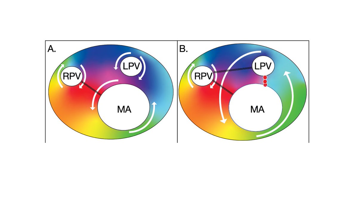 EP Lab Digest (@eplabdigest) on Twitter photo From the June Issue! Atypical Atrial Flutter: Strategies for Successful Circuit Identification and AblationĀ
<a href="/rainylakedana/">Dana Johnson MD MPH</a> @FindingSinus okt.to/xetHzy #EPeeps From the June Issue! Atypical Atrial Flutter: Strategies for Successful Circuit Identification and AblationĀ
<a href="/rainylakedana/">Dana Johnson MD MPH</a> @FindingSinus okt.to/xetHzy #EPeeps