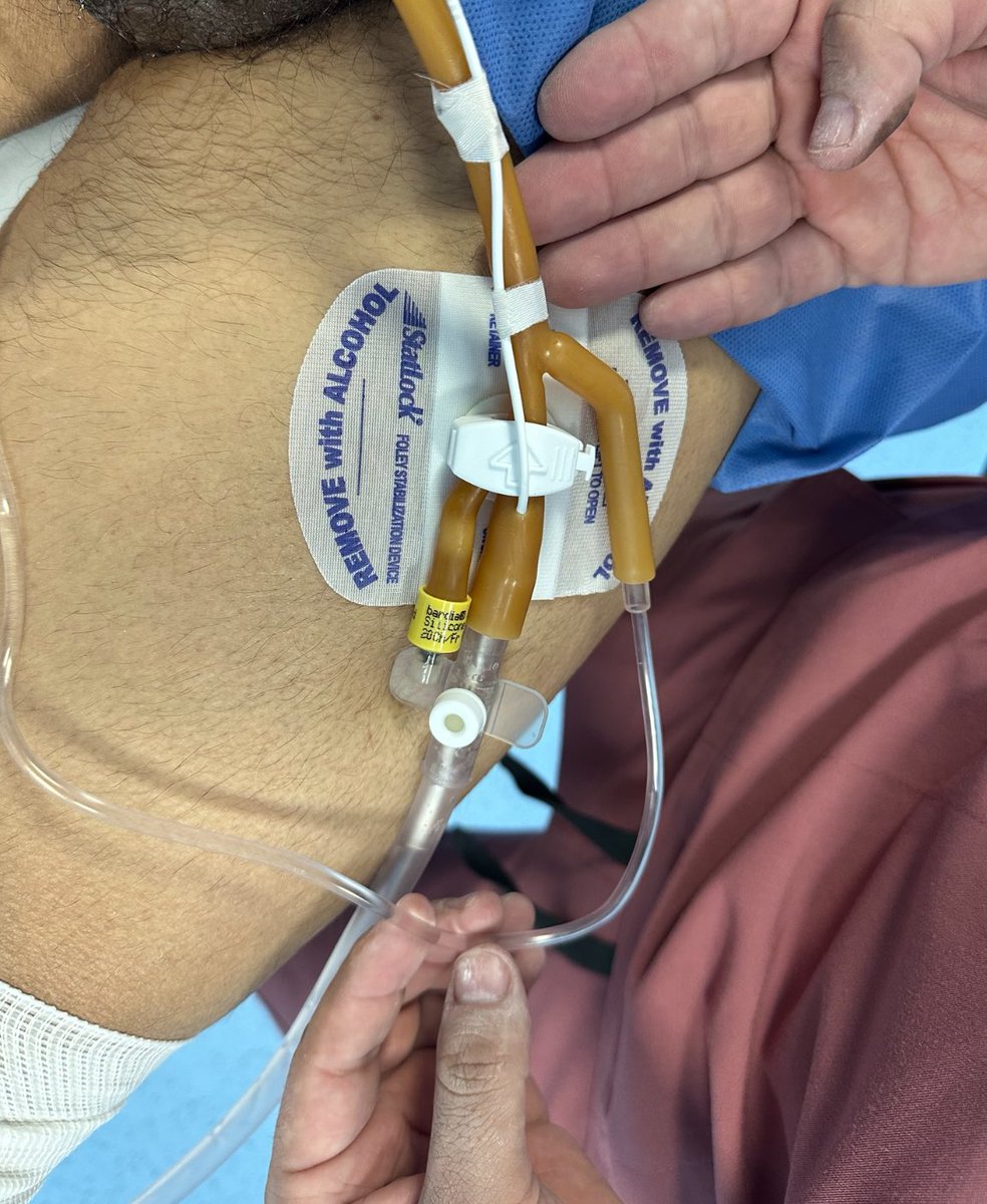 Bruce Rubí HoLEP 🇲🇽 tweet media