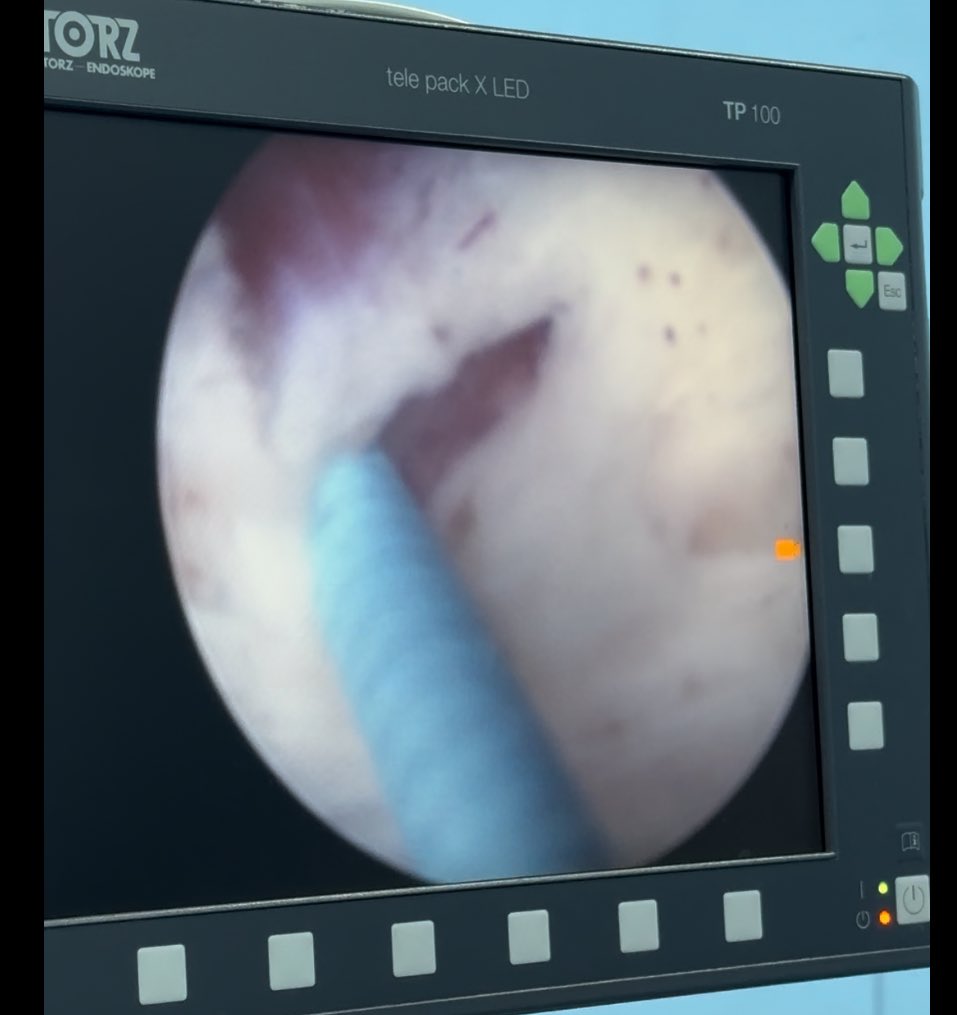 Bruce Rubí HoLEP 🇲🇽 tweet media