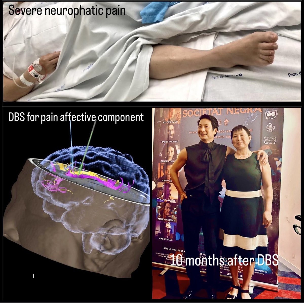 ☑️Unidad de Neuromodulacion y Dolor en <a href="/hospitaldelmar/">Hospital del Mar</a> 
DBS en el componente afectivo del dolor  y Terapia ACT como tratamiento al dolor neuropatico severo y refractario