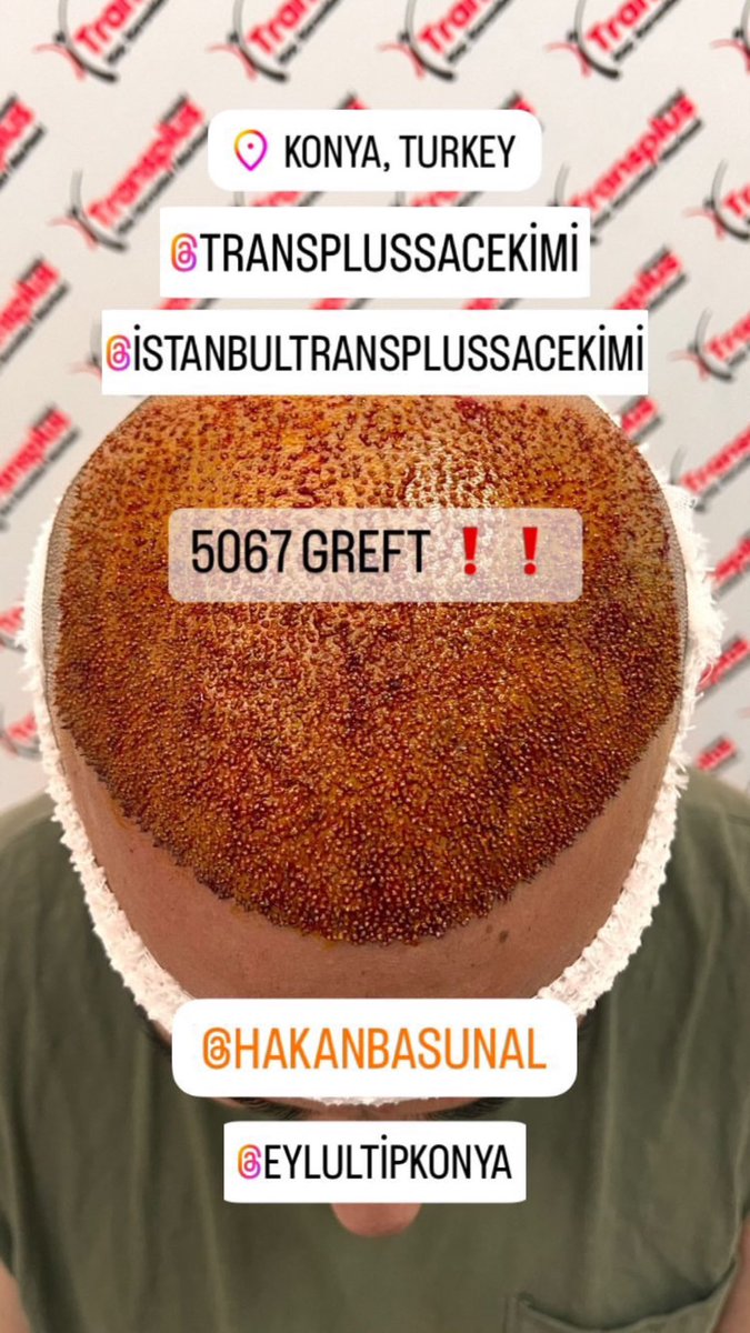 Bir karar verirsin, her şey değişir😉👍 

#saçekimi nde önemli aşamalar;
❗️3. Gün ilk yıkama
❗️7. Gün dairesel yıkama (kabukların çatlak görüntü oluşturması)
❗️ortalama 12. Gün; tüm kabukların dökülmesi
❗️ortalama 60 gün; ekilen tüm saçların kökleri deri altında kalarak dökülmesi