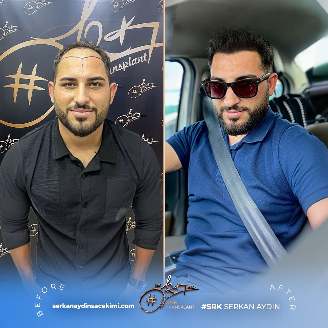 Arenamedd's tweet photo. Die perfekte Verwandlung unseres Patienten in 10 Monaten 🤩
#canahmetkılınç
Kontaktieren Sie uns für eine Haaranalyse 📱

#serkanaydin #maximumgrafts #hairtransplant #beardtransplant #stemcell #haartransplant #Stammzellen #maximalgraft #maximaktransplantation #barttransplant https://t.co/e7pagB81GA
