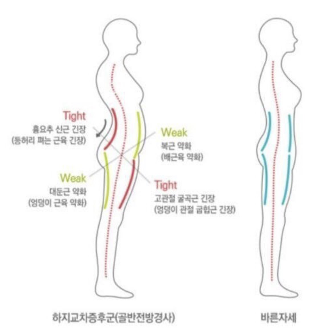 yeoyeoeoch9731's tweet photo. 평소 허리를 꺾어서 배를 내밀고 다닌다?
서있는 모습을 옆에서 봤을 때 마이클 잭슨처럼 기울어져있다?
-> 전방경사입니다(바로 나!)
목 허리 무릎 모든 관절에 좋지 않으니 사진에 나온 약한 근육은 강화하고 타이트한 근육은 풀어주셔야해요!!
(실지로 운동 열심히 하면 안 기울어지더라구요!!) https://t.co/HKV7xetCPx
