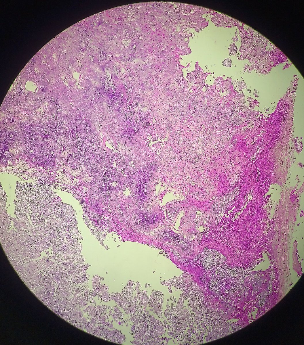 Shruti79688953's tweet photo. #tenosynovialgiantcelltumor with predominant calcification
#pathlove https://t.co/U3HupjxC0R