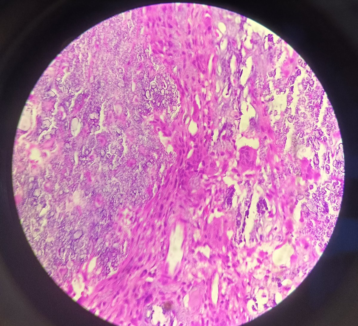 Shruti79688953's tweet photo. #tenosynovialgiantcelltumor with predominant calcification
#pathlove https://t.co/U3HupjxC0R