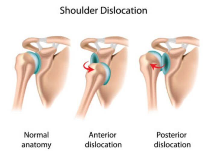 DrJeffPadalecki's tweet photo. Knowing the symptoms of a shoulder dislocation is key for early intervention. These include muscle spasms, severe pain, limited arm mobility, numbness, a “popping” sensation, shoulder displacement, bruising, and weakness. https://t.co/kPii6U27ig #ShoulderCare #InjuryPrevention https://t.co/QuavnfXOPq