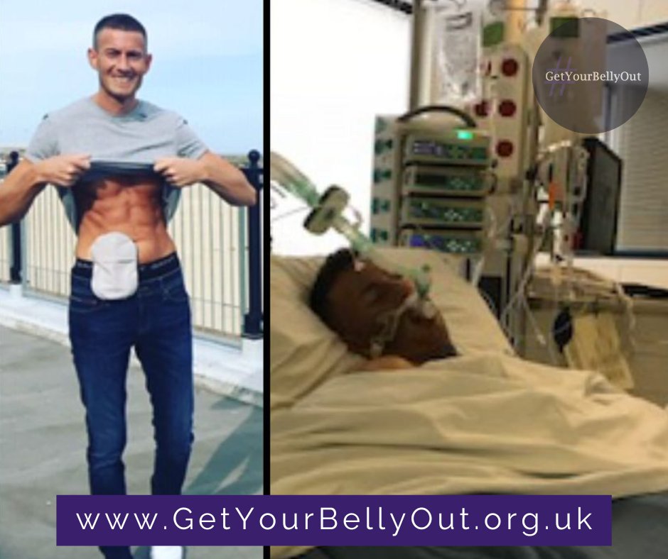 GetYourBellyOut's tweet photo. When I was 13 years old I was diagnosed with Ulcerative Colitis, after years of tests, medications, colonoscopies, X-rays, CT scans etc.

In 2017 when I was 28 years old I was told the only option left for me was to have a total colectomy which means they removed my whole colon. I had also been diagnosed with liver disease due to the inflammation in my colon spreading to the bile ducts in my liver.

It was in June 2018 that I had my second surgery called a pan proctocolectomy, which means they removed all the rectal stump and my ileostomy is now a permanent fixture for me.

After both of my operations, I had complications resulting in me being on life support but now my recovery is going well and I’m happy to be raising awareness for invisible illnesses such as Ulcerative Colitis and Crohn's Disease.

My stoma saved my life, as well as many others, so we should wear our Stoma bags with pride!!"

Bryce, you're the true definition of an IBD warrior! 💪

____
*Details listed above may have changed since the story was first shared with @GetYourBellyOut to help raise awareness. 

Please leave a 💜 in the comments as a sign of your support for the brave individuals who share their experiences to make us all feel less alone in our journey with Inflammatory Bowel Disease.