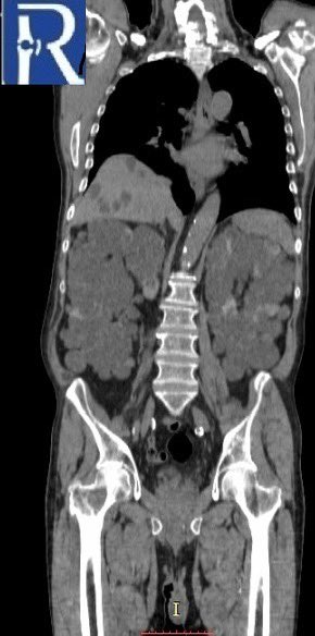 radiologybmj's tweet photo. A 70-year-old male patient with rectal cancer, under follow-up, was admitted with right hip pain.#radiology #mskrad #radtwitter #radstudent #radres #radtwitter #oncology #oncotwitter #medstudent #medtwitter #medtweet #MedStudentTwitter #bonemetastasis #browntumor #cancer https://t.co/EuxkC8aKnJ