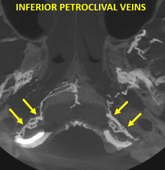 #BANANA2024 in person (only) 3-day course will be on October 14-16. Registration is OPEN! shorturl.at/JHbV3 We have early bird discounts this time. In the meantime, anatomy around the cavernous sinus as shown on a #CBCT obtained through injection of an IPS.
