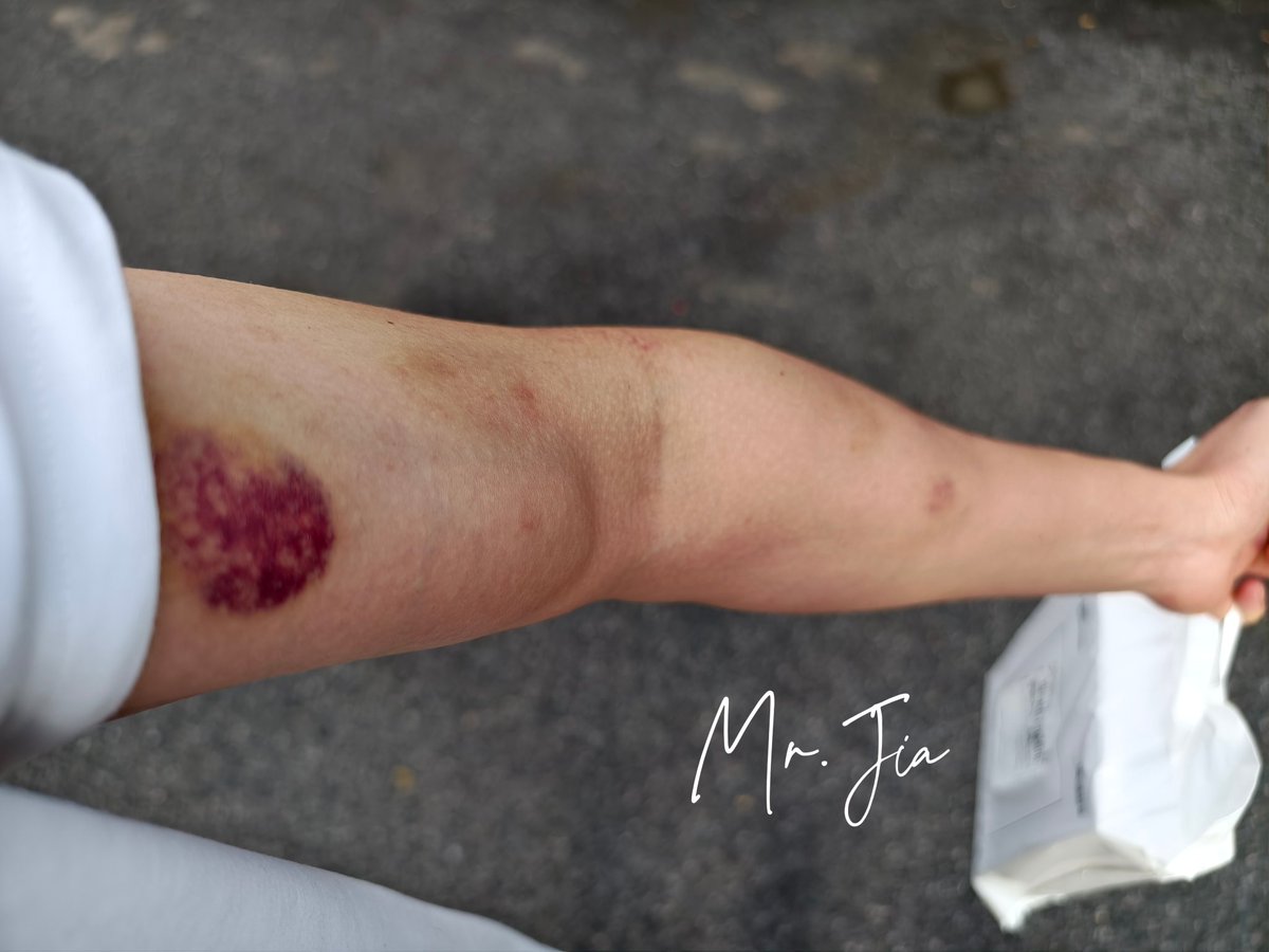 ·勇攀高峰、再接再厉～
·小王八盖子的……

-“那…你妈妈要是看到了，你就说你拔罐了！”
-“不了，我妈昨天看到就直接问我用不用打针狂犬疫苗了。我说不用，没咬破😑”

·鉴于，妹妹跟我实在能耐太大了，现诚心希望认识一位北京有经验的女主，你来揍，希望可以欣赏到星空紫，有意的美女姐姐请私信嗷！