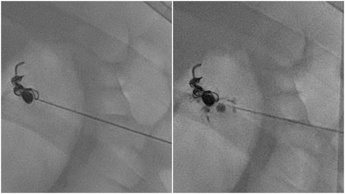 Subcapsular splenic hematoma  ⬅️ pseudoaneurysm ⬅️ pancreatitis.

Drainage f/b front and back door coil embolisation of parent artery.

PSA starts filling from gastroepiploic artery🤯

Percutaneous trans-splenic glue embolisation to the rescue.

With <a href="/shobhit_IR/">SHOBS</a> and <a href="/akhilbaby55/">Akhil Baby</a>