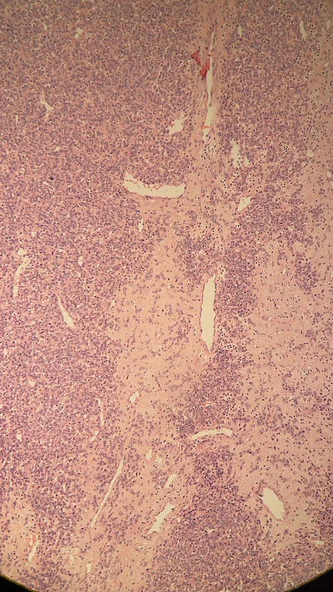 MAHoureih's tweet photo. 1/4 #GUpath #BSTpath 🧑‍🦰Early twenties. Kidney mass. @MayaNourieh @HubertLauMD @LaraHarikMD @FKhaniPath @FionaMacPath @Kiril_T_Can @bansar7 @RenalGUPath @rovingatuscap @DrRanasaleh @xenaalabbas @ariella8 @kis_lorand @DrGeeONE @TristanRutland7 @RibianszkyA @MirunaPopescu13 https://t.co/qsislvP2tD