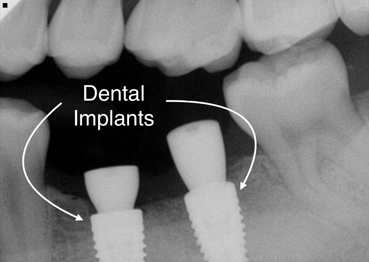 FrandsenDDS's tweet photo. Dental implants.  The best way to replace a missing tooth.  🦷😎😁  #IdahoFallsSmiles #dentalimplants #missingtooth #straumannimplants #implantdentistry #familydentistry #cosmeticdentistry #sedationdentistry #idahofallsdentist #idahodentist #bestteam #bestdentists https://t.co/W1NO6BtZVK