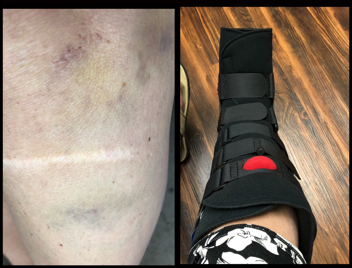 PTSDAdvocate's tweet photo. @anartdecodiva @ibdgirl76 meds when I fell. I severely sprained my (R) ankle & foot. Partially tore my (L) ACL. The bruise below the knee is due to a screw holding everything tightly in place from a prior surgery, hence the tear.
#MedicallySupervisedHarm
2/2 https://t.co/n0011rQDdD