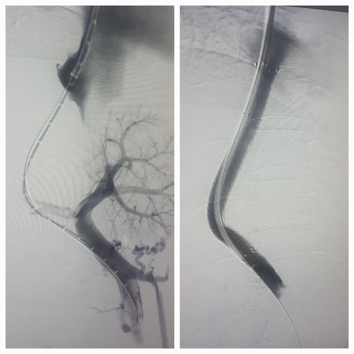 Dr Saurabh kumar Interventional radiologist tweet media
