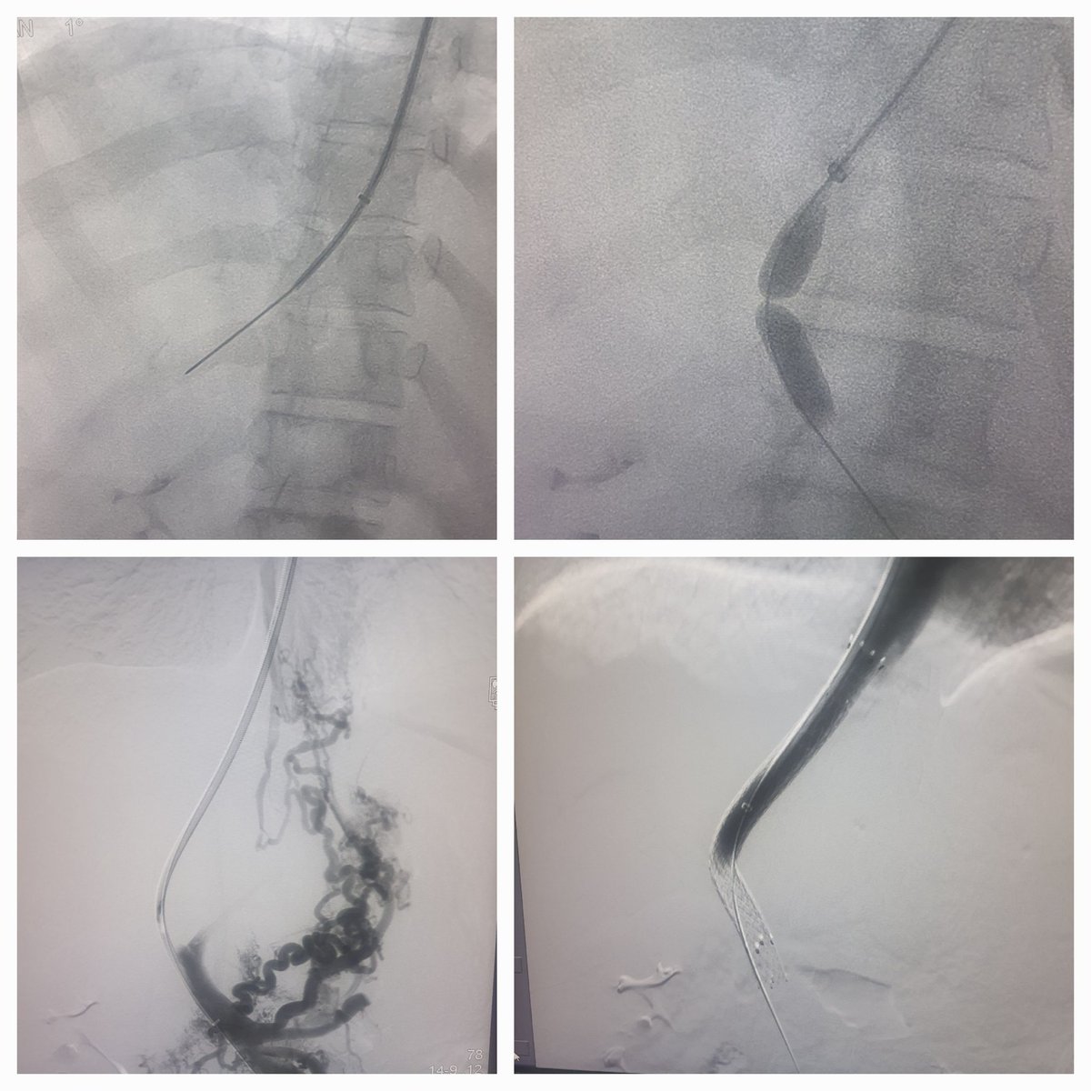 Dr Saurabh kumar Interventional radiologist tweet media