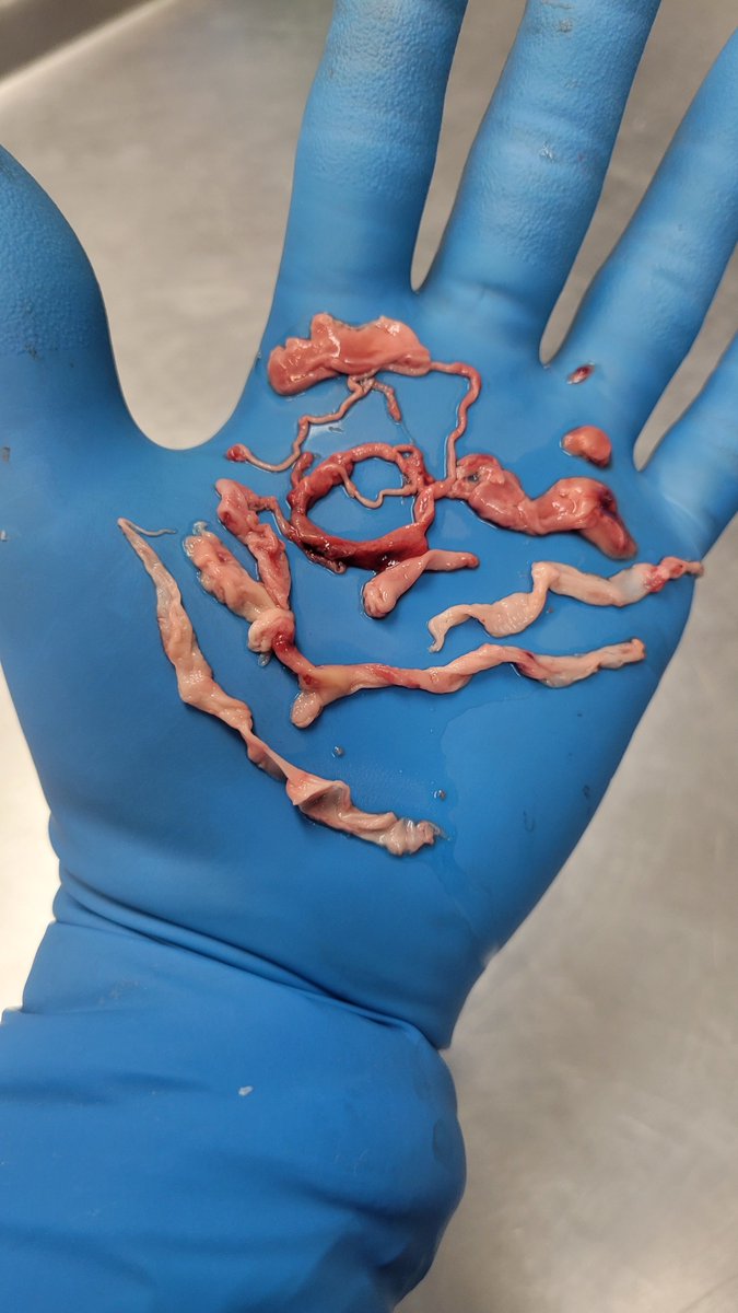 Just 3 separate cases in June 2024. The abnormal clotting continues. These strange clots started showing up in early 2021 after the rollout of the vaccine. Is this what's causing it? I believe it is.
Ignoring this issue is not going to make it go away. 
My first 20 years of