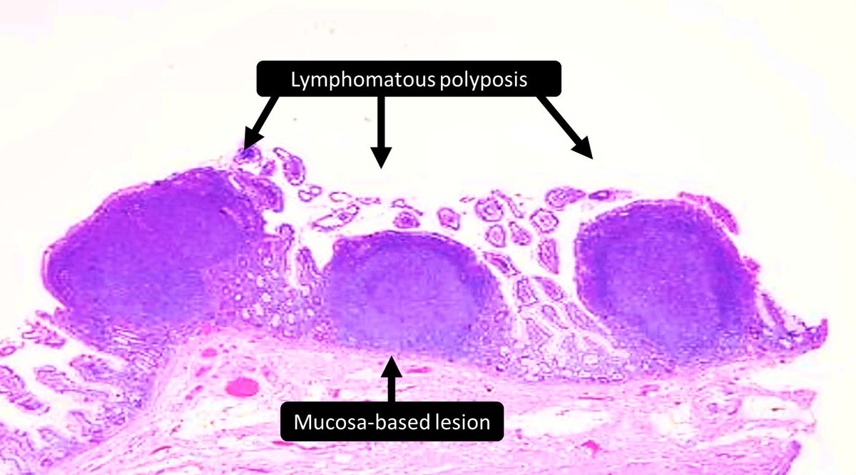 Duodenal-type ____ lymphoma is an ___ lymphoma
a) follicular
b) mantle cell
c) MALT
d) burkitt
#GIPath #HemePath #PathTwitter #Pathology