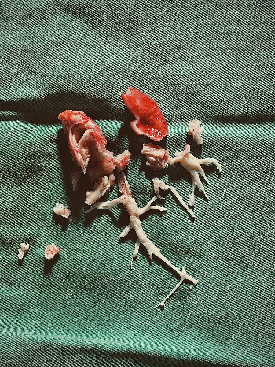 HtAnest's tweet photo. Pulmonary embolism  (PE) https://t.co/4lTvUqmiEZ