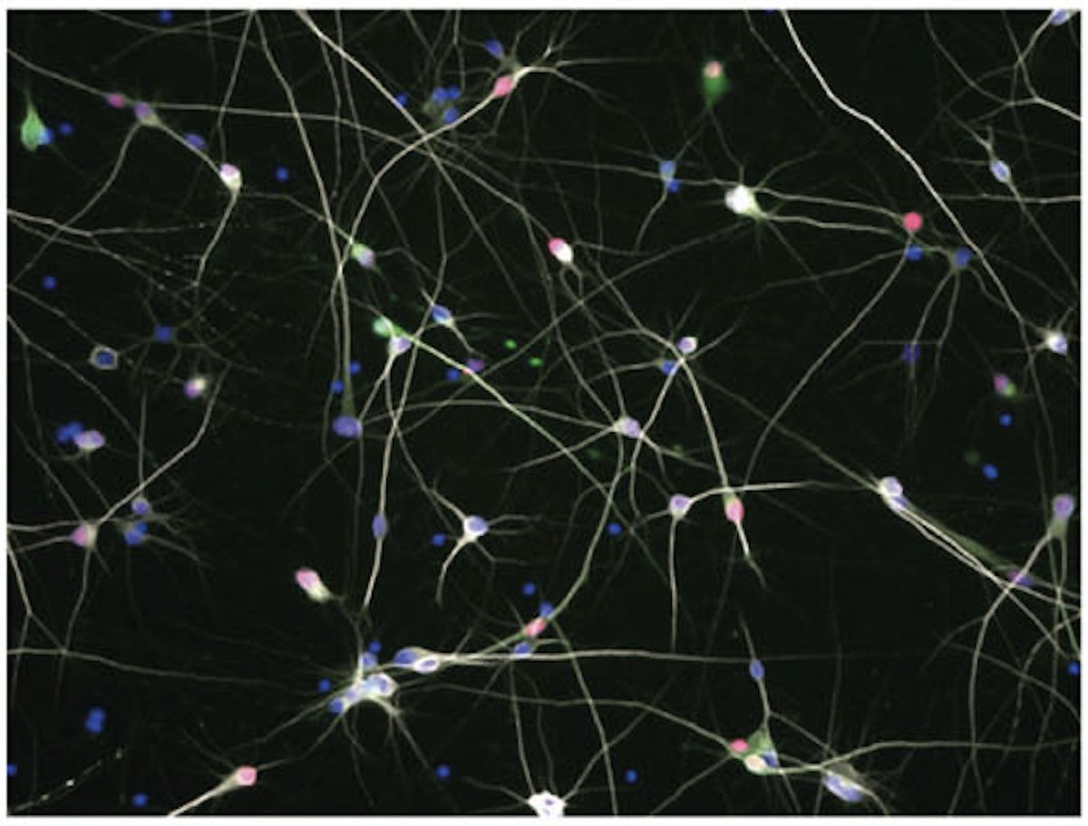 Journal of Huntington's Disease (@journal_hd) on Twitter photo Researchers <a href="/UnivParisSaclay/">Université Paris-Saclay</a> report a novel collection of HTT knockout human iPSCs implicating HTT in
➡️Neuro-epithelial and striatal neuron maturation
➡️DNA repair
➡️BDNF axonal transport in post-mitotic neurons:
content.iospress.com/articles/journ… Researchers <a href="/UnivParisSaclay/">Université Paris-Saclay</a> report a novel collection of HTT knockout human iPSCs implicating HTT in
➡️Neuro-epithelial and striatal neuron maturation
➡️DNA repair
➡️BDNF axonal transport in post-mitotic neurons:
content.iospress.com/articles/journ…