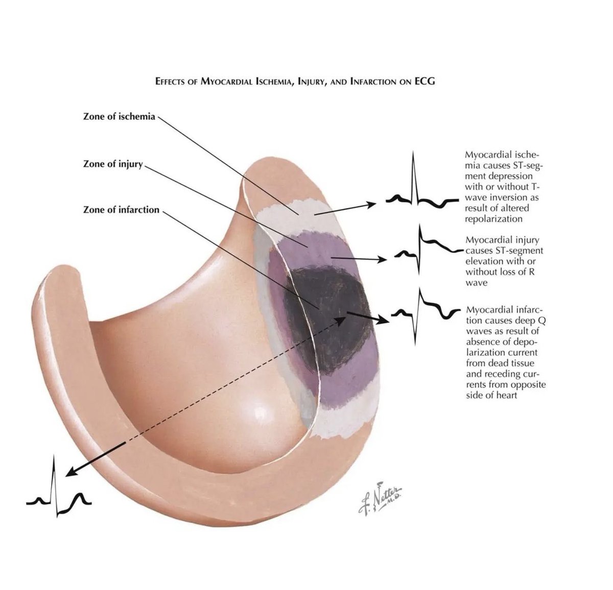 EKG changes and  Myocardial injury explained: ST elevation vs. ST depression and more.