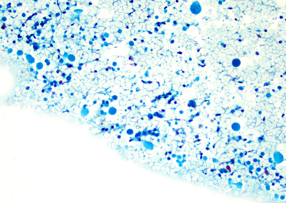 Zahra Maleki, MD, MIAC (@zmaleki_cyto) on Twitter photo Bublle gum here, bubble gum there.
Bubble gum colloid droplets, many of them in a papillary thyroid carcinoma. They are magenta in Diff-Quik stain and green in Papillary stain. #CytoPro, #cytology #thyroid <a href="/IvanaKholova/">Ivana Kholová</a> <a href="/mdlozanoe/">Lola Lozano</a> <a href="/DianaEstherossi/">Esther Diana Rossi</a> <a href="/aakasharmand/">Zubair Baloch</a> <a href="/bfaquin/">WC Faquin, MD, PhD</a> Bublle gum here, bubble gum there.
Bubble gum colloid droplets, many of them in a papillary thyroid carcinoma. They are magenta in Diff-Quik stain and green in Papillary stain. #CytoPro, #cytology #thyroid <a href="/IvanaKholova/">Ivana Kholová</a> <a href="/mdlozanoe/">Lola Lozano</a> <a href="/DianaEstherossi/">Esther Diana Rossi</a> <a href="/aakasharmand/">Zubair Baloch</a> <a href="/bfaquin/">WC Faquin, MD, PhD</a>