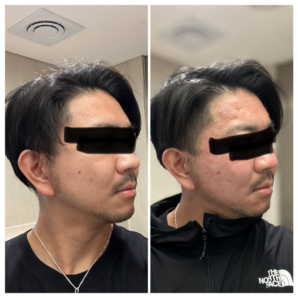 本日の施術

１．無痛リジュランオールキル
-ポテンザポンピング+MLA+マックーム2㏄+リジュラン2㏄+ソノケア+鎮静パック
２．リジュラン２㏄追加
３．ジュベルックスキンブースター４cc

明日以降が楽しみ
＃カンナム
＃韓国
＃メンズ美容
＃整形
＃ポテンツァ
＃リジュラン
＃スキンブースター