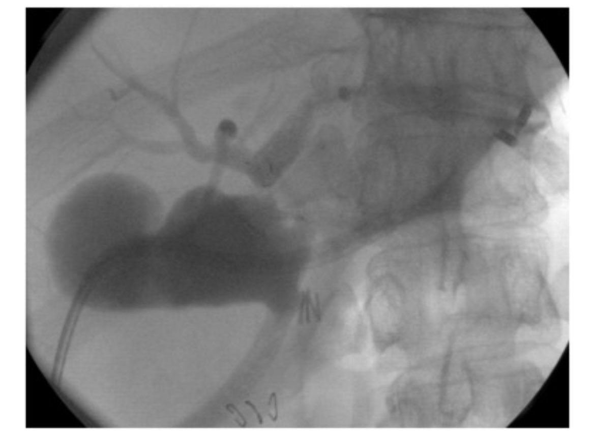 amartega's tweet photo. Happy to share our last @videogie 

Definitive endoscopic repair of transected bile ducts after cholecystectomy using EUS-guided hepaticogastrostomy and retrograde cholangioperitoneoscopy

Thank you #ManuelPerezMiranda and collaborators @AparatoDigesti1 

 https://t.co/cF8qXFFmJn https://t.co/Sec6XjKfmV