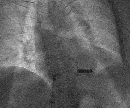 EPWaveDoc's tweet image. After #Micra #leadless #pacemaker implantation in a 109 yo pat (DOB 1914) w complete heart ❤️ block I was recently invited to celebrate 🍾 her anniversary. Procedure w #fellowsfirst Mickaël Cohen @CHUM972 #CaribbeanCardiology 🏝️ #Epeeps #Cardiology @EloiMarijon @WaintraubX