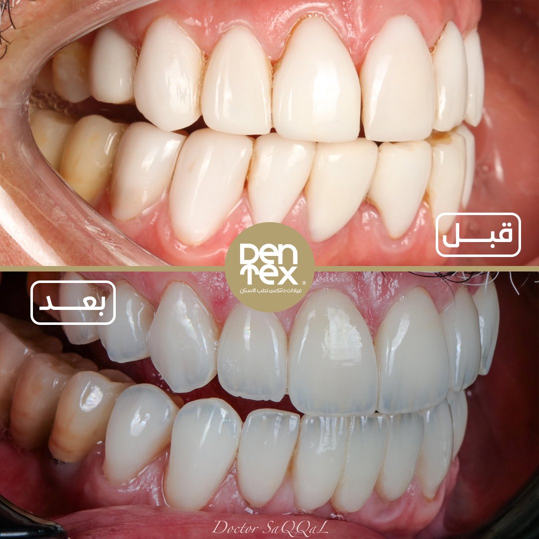 dentexclinic's tweet photo. @dr_saqqal’s magic touch 🪄 https://t.co/3K8QfhTiPA