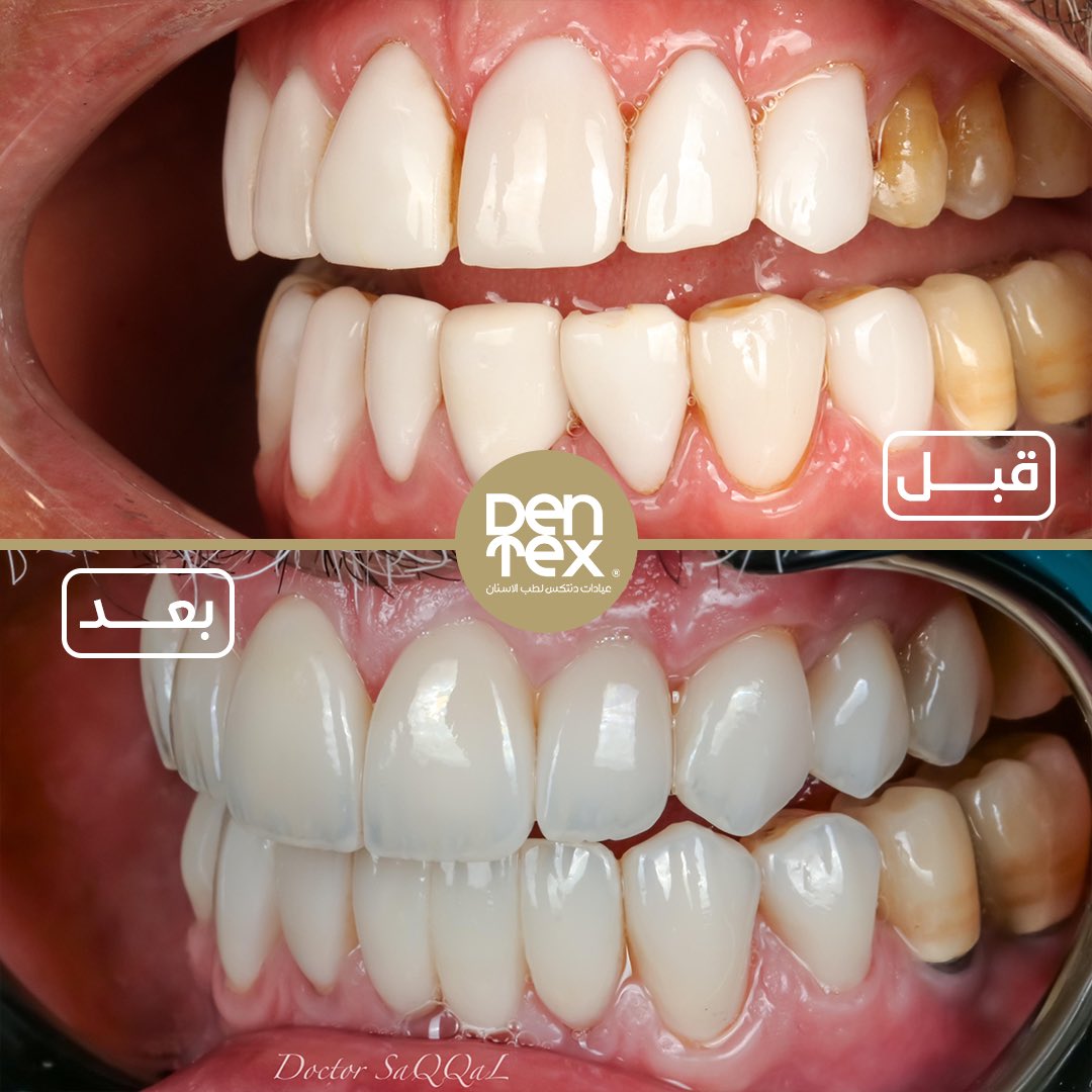 dentexclinic's tweet photo. @dr_saqqal’s magic touch 🪄 https://t.co/3K8QfhTiPA