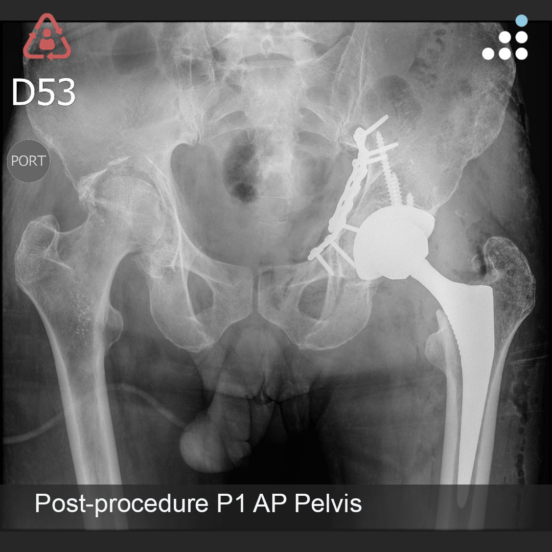 orthobullets's tweet photo. Here are intra-op & post-op of images of Procedure 1 (1 of 2) of yesterday's case by Dr. Rodrigo Pesantez and Fundación Santa Fe de Bogotá (@FSFB_Salud)

BILATERAL ACETABULAR FX WITH RIGHT FEMORAL NECK FX IN 67M

Procedure 1 (posted today): Left Acetabular FX ORIF + Left THA
Procedure 2 (posting tomorrow): Right Acetabular FX ORIF + Right THA

Here is the link to the pre-op imaging: https://t.co/3nBy6e7d83

Leave a comment and keep the great conversation going! #orthotwitter

Please contribute to our community and vote on this case on OB: https://t.co/OGZdYpwm85