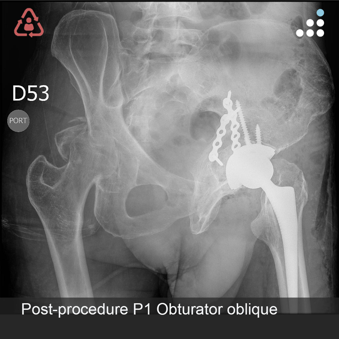 orthobullets's tweet photo. Here are intra-op & post-op of images of Procedure 1 (1 of 2) of yesterday's case by Dr. Rodrigo Pesantez and Fundación Santa Fe de Bogotá (@FSFB_Salud)

BILATERAL ACETABULAR FX WITH RIGHT FEMORAL NECK FX IN 67M

Procedure 1 (posted today): Left Acetabular FX ORIF + Left THA
Procedure 2 (posting tomorrow): Right Acetabular FX ORIF + Right THA

Here is the link to the pre-op imaging: https://t.co/3nBy6e7d83

Leave a comment and keep the great conversation going! #orthotwitter

Please contribute to our community and vote on this case on OB: https://t.co/OGZdYpwm85