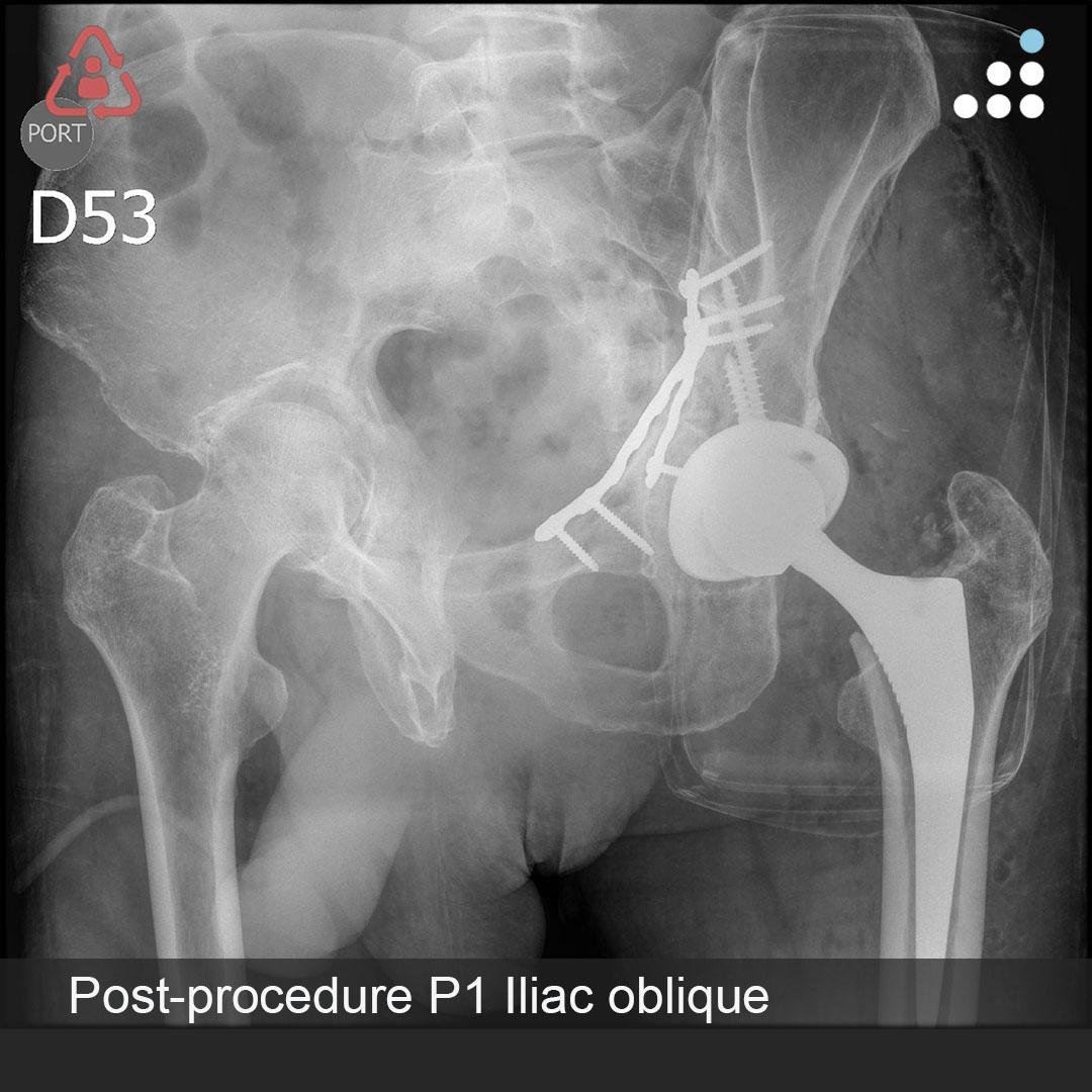 orthobullets's tweet photo. Here are intra-op & post-op of images of Procedure 1 (1 of 2) of yesterday's case by Dr. Rodrigo Pesantez and Fundación Santa Fe de Bogotá (@FSFB_Salud)

BILATERAL ACETABULAR FX WITH RIGHT FEMORAL NECK FX IN 67M

Procedure 1 (posted today): Left Acetabular FX ORIF + Left THA
Procedure 2 (posting tomorrow): Right Acetabular FX ORIF + Right THA

Here is the link to the pre-op imaging: https://t.co/3nBy6e7d83

Leave a comment and keep the great conversation going! #orthotwitter

Please contribute to our community and vote on this case on OB: https://t.co/OGZdYpwm85